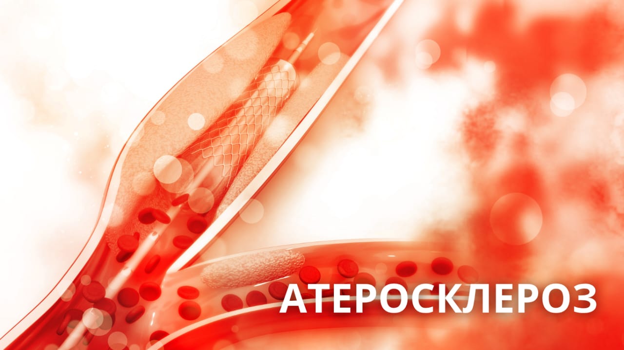 Атеросклероз сосудов ног