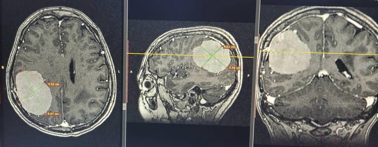Нейрохирурги Национального госпиталя случайно обнаружили у пациентки гигантскую опухоль мозга