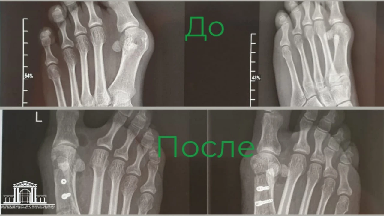 Лечение вальгусной деформации большого пальца стопы в Центральной клиническо больнице СОВМИНКЕ 