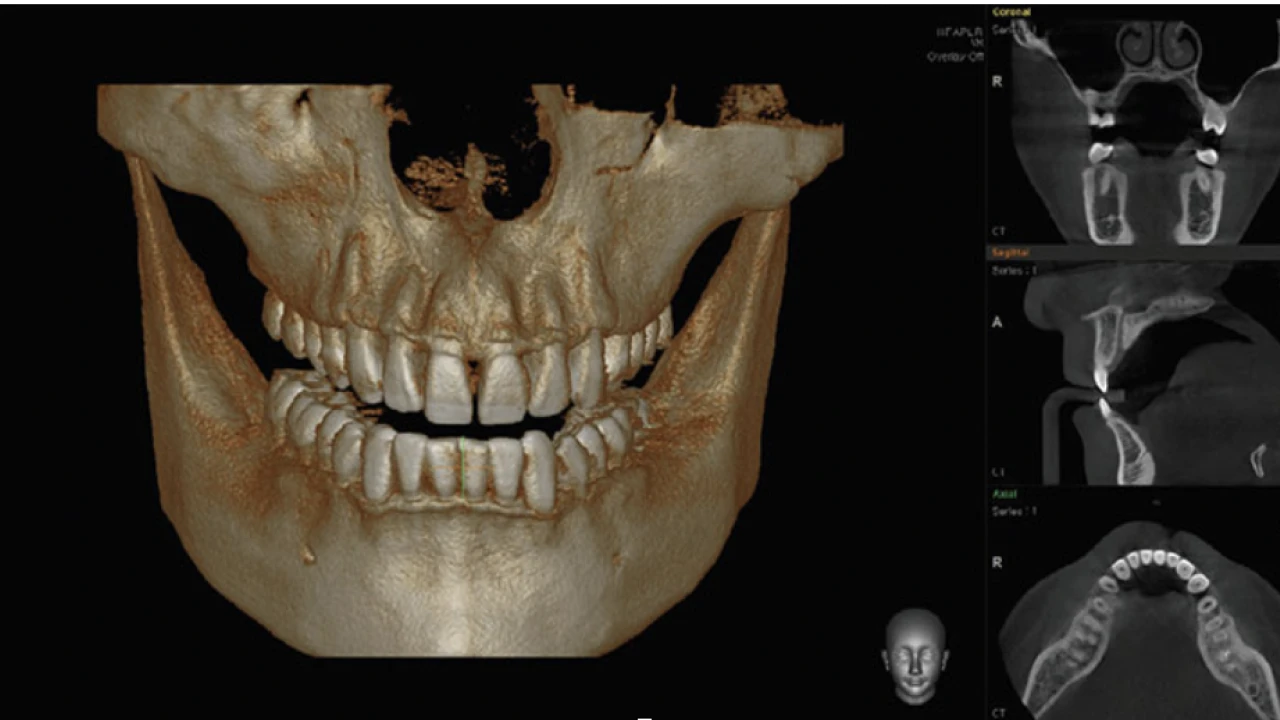 Компьютерная томография зубов: 3D диагностика челюсти 