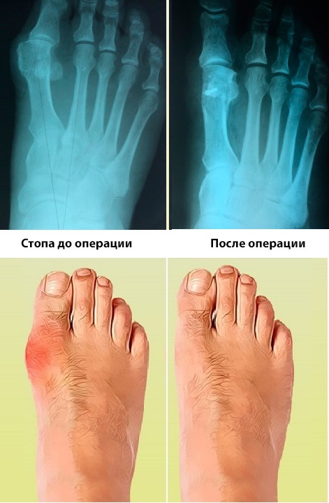 Лечение вальгусной деформации большого пальца стопы.