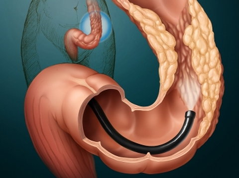 Профилактика рака толстой кишки.