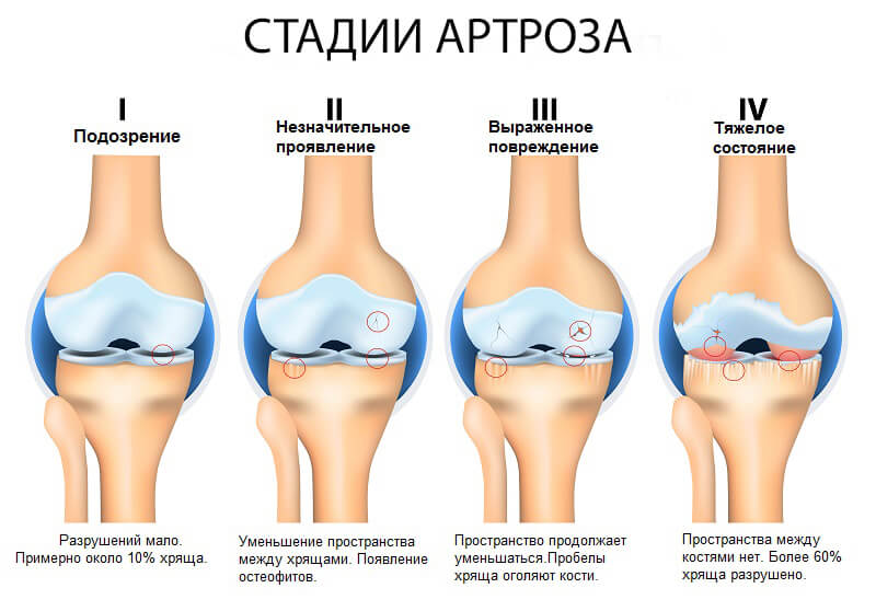 Новое в лечении артрозов - SVF терапия