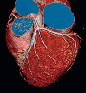МСКТ – коронарография - мультиспиральная компьютерно томографическая коронарография
